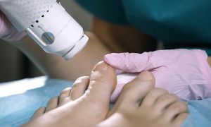 Does Laser Treatment Work For Toenail Fungus? 